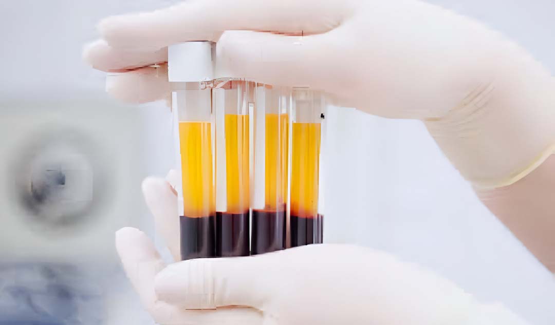 Plasma Rico en Plaquetas (PRP)